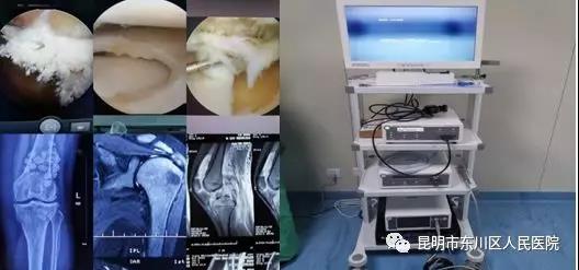 東川區(qū)人民醫(yī)院外二科開(kāi)展新技術(shù) 美國(guó)施樂(lè)輝關(guān)節(jié)鏡系統(tǒng)投入使用